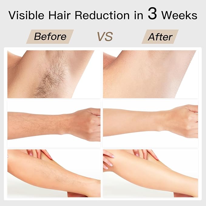 BOSIDIN LASER - PERMANENT HAIR REMOVAL DEVICE