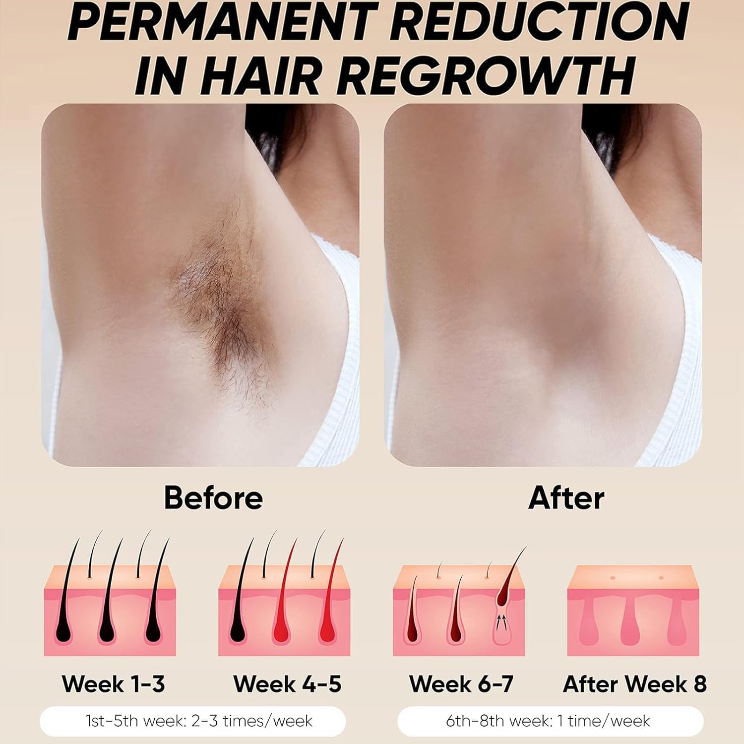 BOSIDIN LASER - PERMANENT HAIR REMOVAL DEVICE